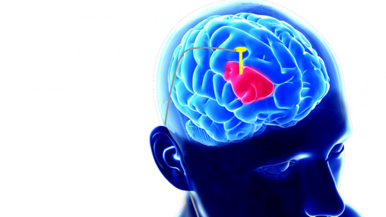 Deep brain stimulation (DBS) devices are commonly utilised to treat a variety of neurological conditions.