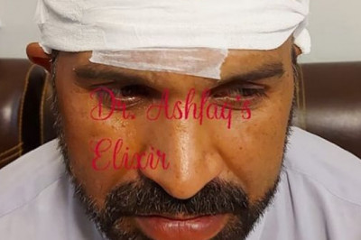 Who Can Get Advantage From Hair Transplant?