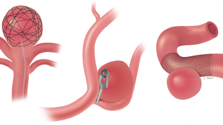 Intracranial Aneurysm Market Potential, Size, Key Performance Indicators, Product Launch Forecast to 2028