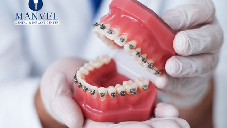 Top 5 Things You Didn’t Know About Cosmetic Braces