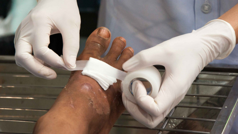 Wound Dressing Market - Global Industry Analysis, Size, Share, Growth, Trends, and Forecast, 2021-2028