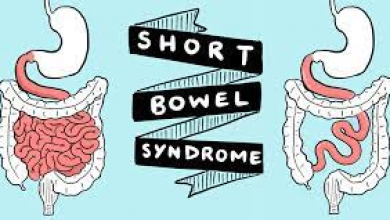 Global Short Bowel Syndrome Market Size, Market Share, Application Analysis, Regional Outlook, Growth Trends, Key Players, Competitive Strategies and Forecasts, 2017 to 2025