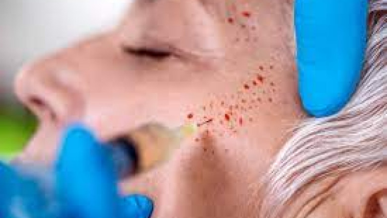 Post PRP Injection Instructions for Face and Hair