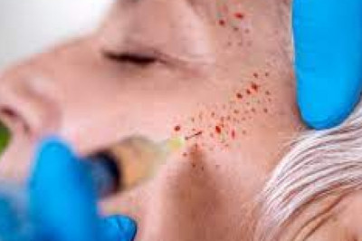 Post PRP Injection Instructions for Face and Hair