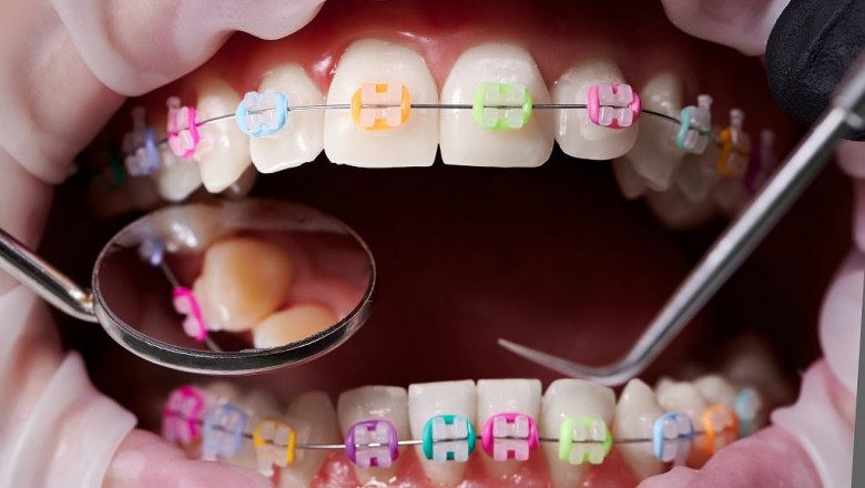 What color braces make your teeth look whiter?