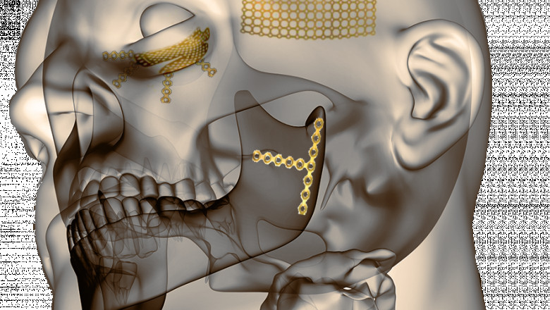 Craniomaxillofacial Implants Market Analysis, Size, Share, Growth, Trends, and Forecast 2019 - 2027