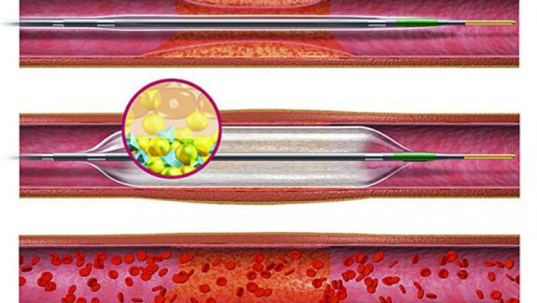 Drug Eluting Stents Market Size, Regional Outlook, Price Trends, Competitive Market Share &amp; Forecast, 2019 - 2027
