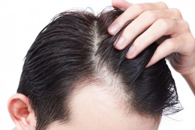 What Are The Factors That Influence Hair Transplant Cost in Gurgaon?