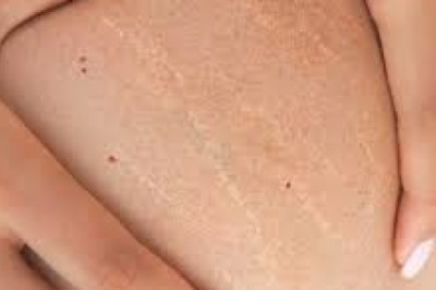 Why Everybody Is Talking About Best Stretch Mark Products