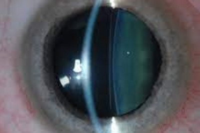 ICL Eye Surgery