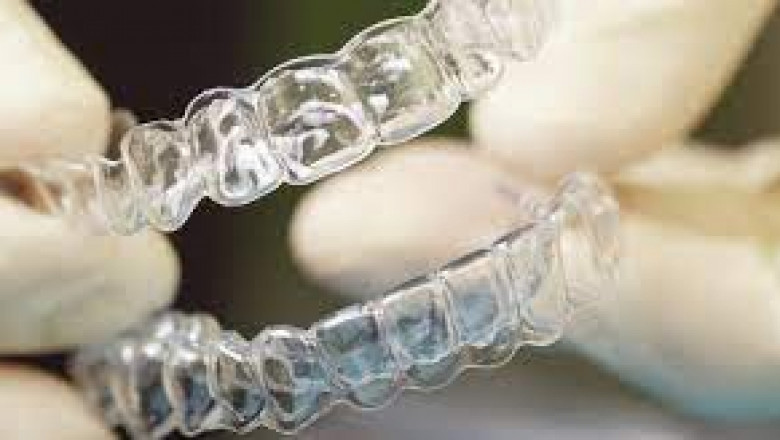 What Are The Frequently Asked Questions About Tooth Extraction?