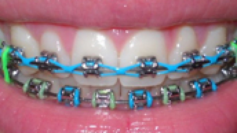 Invisalign treatment in Lennox