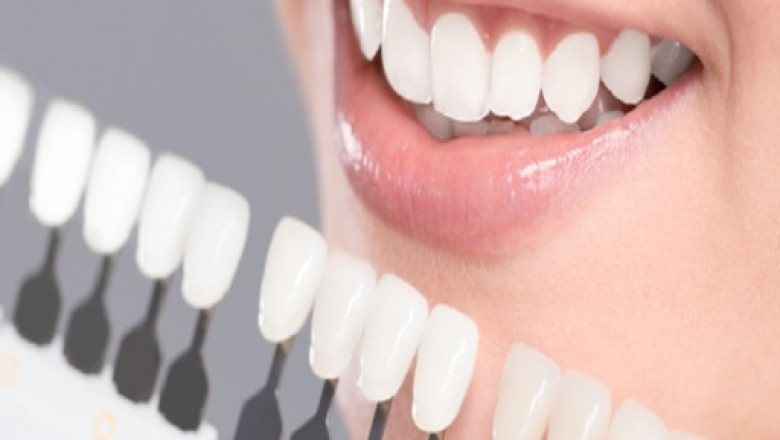 The Benefits of Professional Tooth Whitening | Tower House Dental Clinic