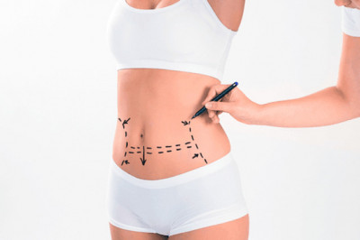 Tummy Tuck Complication Treatment
