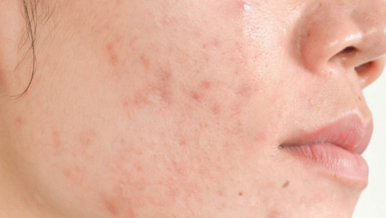10 Common Ingredients in Cosmetics That May Cause Acne