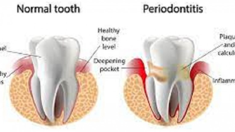 Dental Periodontics Market Size, Share, Forecast, &amp; Industry Analysis 2028