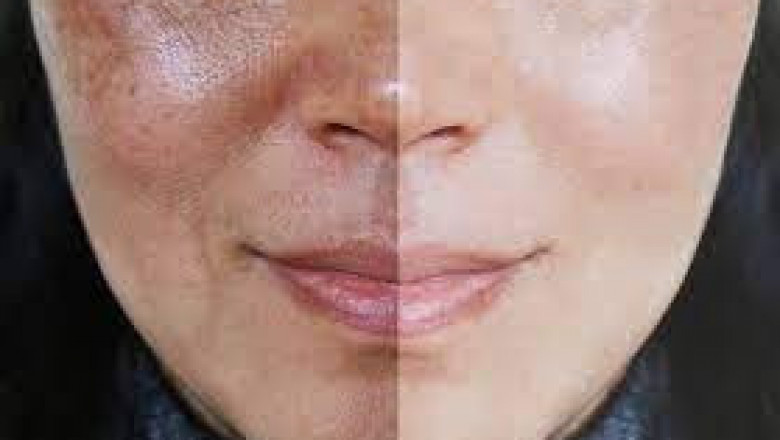 Melasma Treatment Cost In Hyderabad