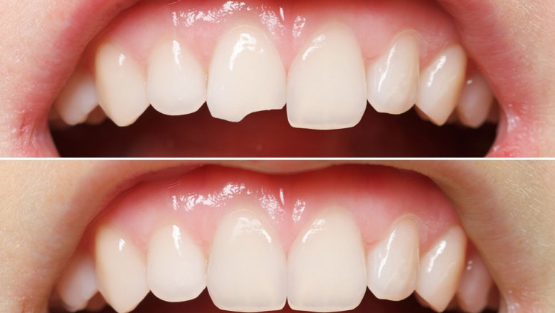 5 Consequences of Tooth Chipped