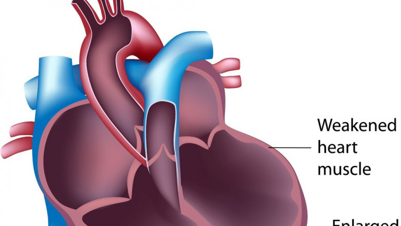 Developed regions are major growth engine of dilated cardiomyopathy market