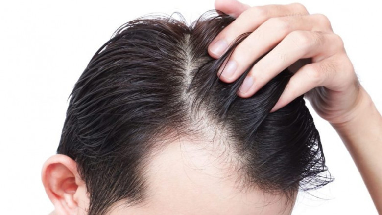 How To Achieve Successful Results With Hair Transplantation?