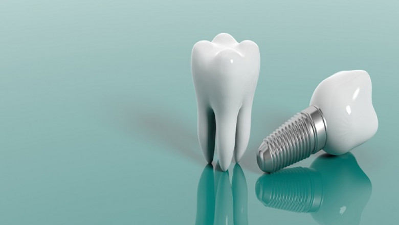 Dental Implants Treatment: Indications And Contraindications