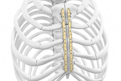 Global Sternal Closure Systems Market | Industry Size, Latest Trends, Key Segments, Region, Forthcoming Developments, and Forecast