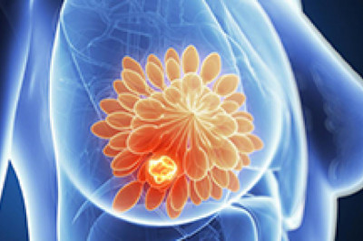 Best Breast Cancer Surgery in India