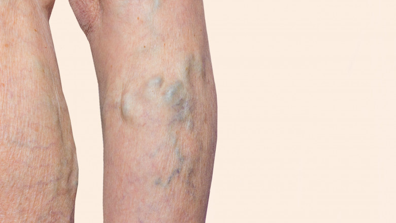 Which Procedure Is Best For Treating Varicose Veins?