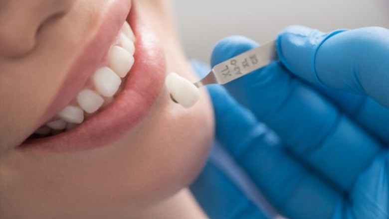 Everything You Need to Know About Dental Crowns.