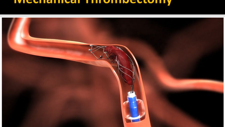 Mechanical Thrombectomy Devices Market 2022 Size, Latest Trend and Key Companies |Research Informatic
