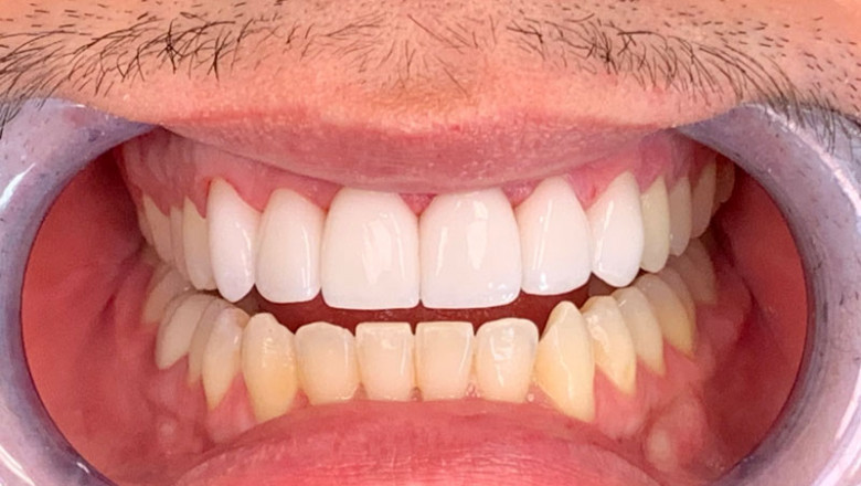 What Are The Types Of Veneers?