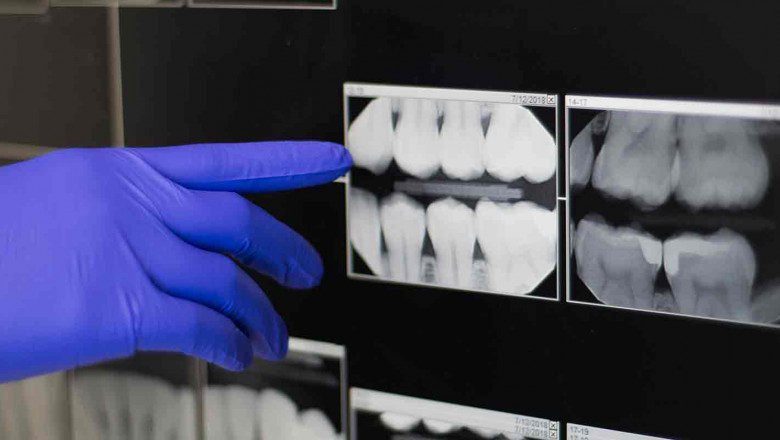 What is Teeth Whitening Treatment?