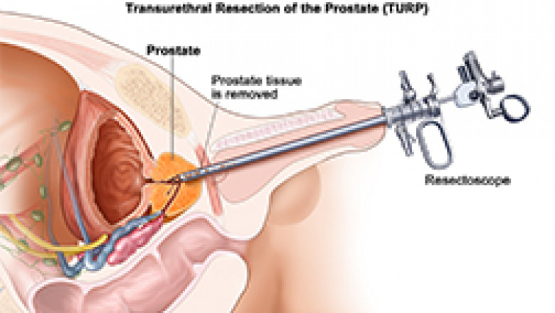 TURP surgery in India