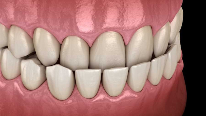 What to Know About Child Underbite?