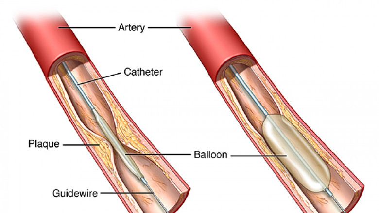 Angioplasty in Pimpri Chinchwad | Best Cardiologist in PCMC | Dr. Kartik Bhosale
