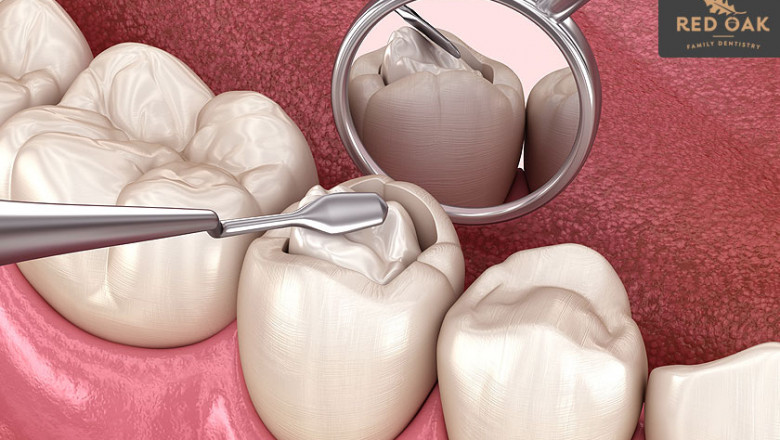 All You Need To Know in Taking Care Of Dental Fillings