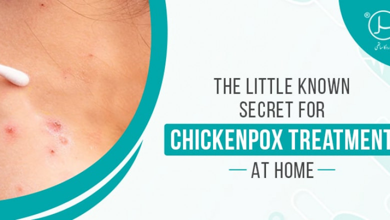 The Little Known Secret for Chickenpox Treatment at Home