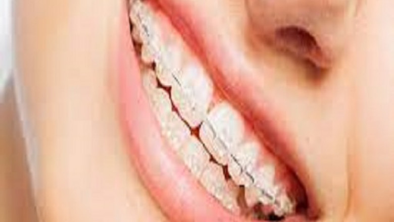 If Your Child Needs Straight Teeth, Consider These 4 Types of Braces