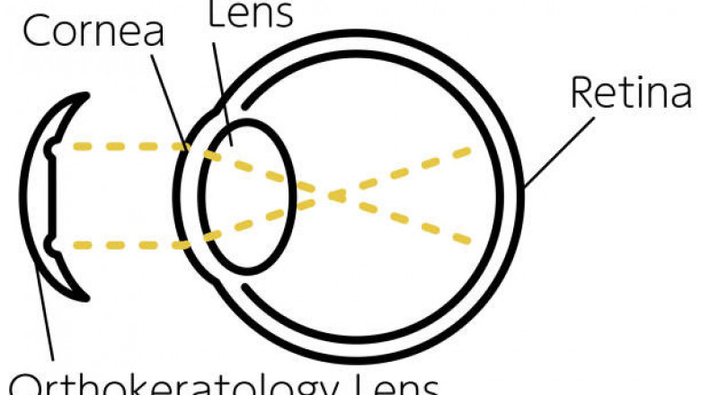 Orthokeratology Lens Market: Increasing Investments in Healthcare Sector of the Country to Boost Growth 2027