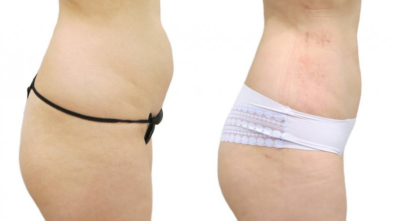 What Is a Brazilian Butt Lift?