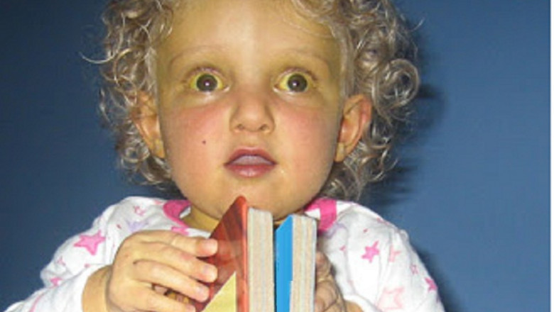 Alagille Syndrome Market Size, Development with Covid19 Impact | Albireo Pharma, Inc, Mirum Pharmaceuticals, Teva Pharmaceutical Industries Ltd, Zydus Cadila