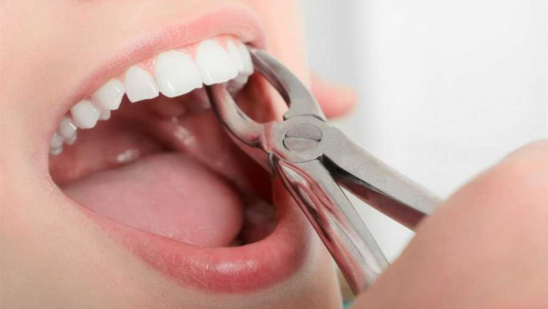 Five Reasons Why A Tooth Extraction Is Necessary?