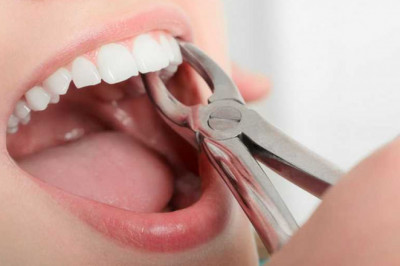 Five Reasons Why A Tooth Extraction Is Necessary?