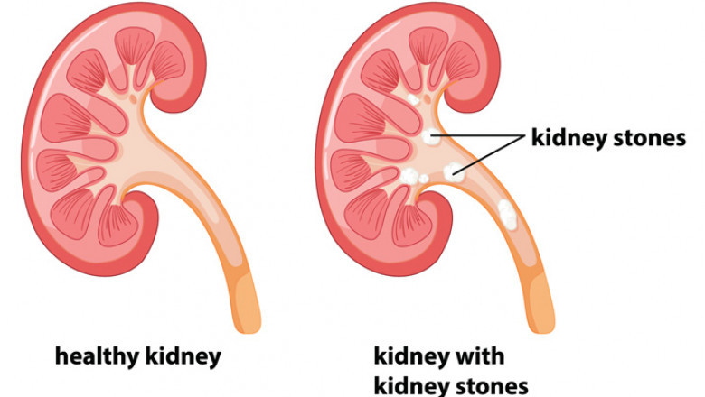 How to Find the Right Kidney Stone Treatment for You