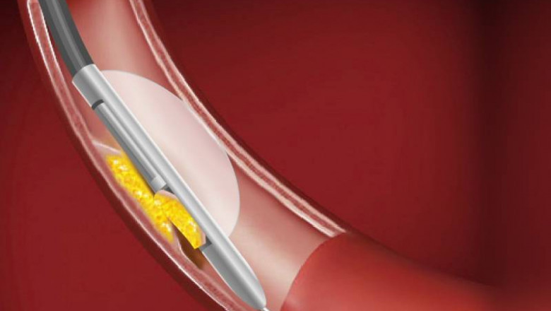 Rotational Atherectomy Theropy in Pune | Dr. Kartik Bhosale