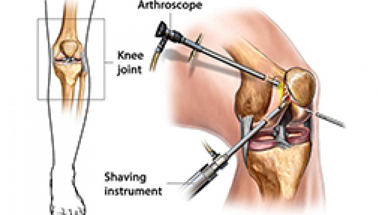 Arthroscopy Surgery in India