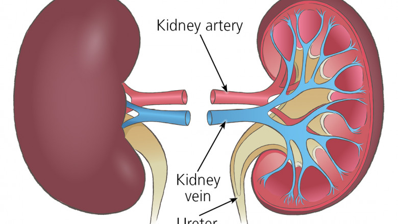 Kidney Transplant Is The Act Of Replacing A Diseased Kidney With A Healthy One