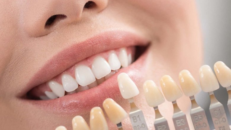 What Are The Pros And Cons Of Veneers?
