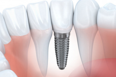 What Do We Understand By Root Canal Treatment?