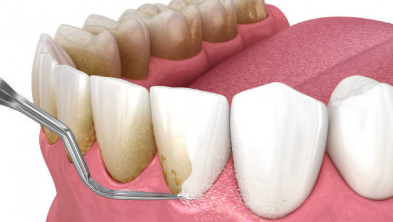 Periodontal Therapeutics Market COVID-19 Research Analysis, Strategic Insights and Forecast to 2027
